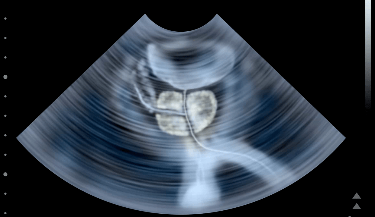 Ultrasound nga pagsusi sa calculous prostatitis