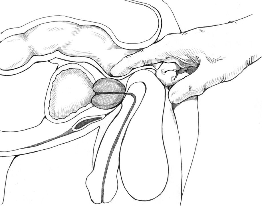 Ang pagmasahe sa prostate gilakip sa komplikado nga pamaagi sa pagtambal sa prostatitis