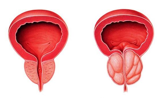 Normal ug inflamed prostate (prostatitis)
